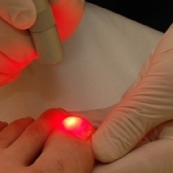 Tratamento a Laser para Micoses de Unha em Florianópolis